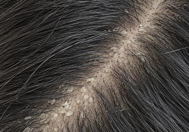 Flaky Scalp