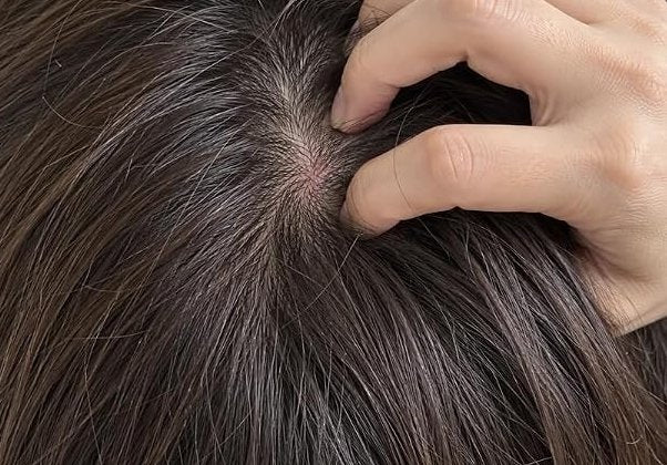Itchy Scalp