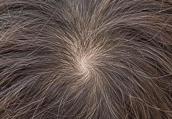Dry, Tight Scalp