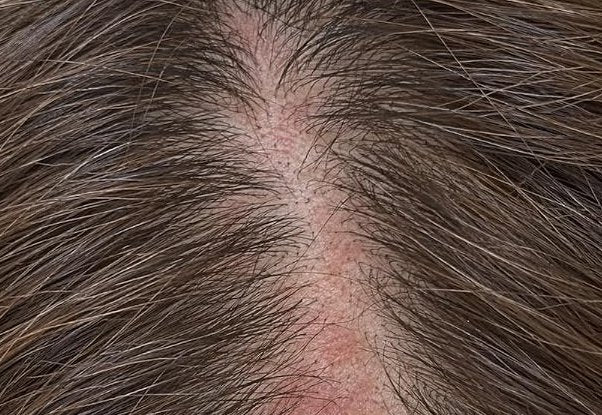Red, Warm Scalp